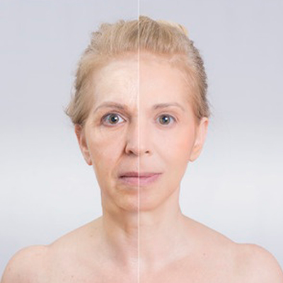 Cirugia Estetica Rejuvenecimiento Facial