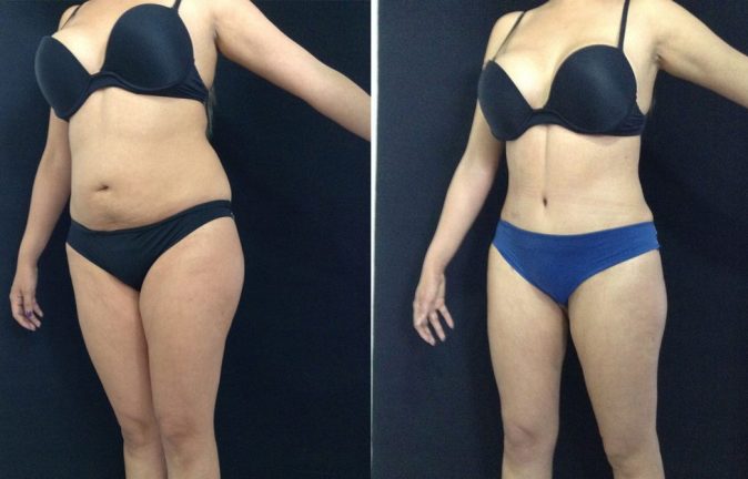 Abdominoplastia Antes y Despues