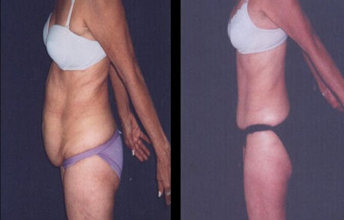 Abdominoplastia En Colombia