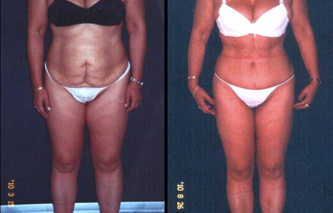 Abdominoplastia Precios