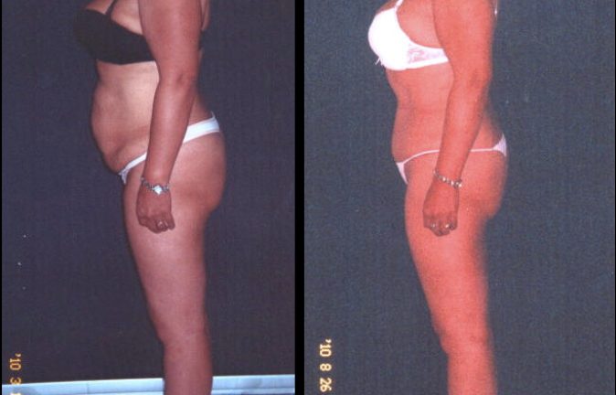 Abdominoplastia Testimonios