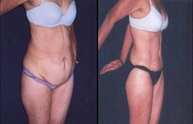 Abdominoplastia