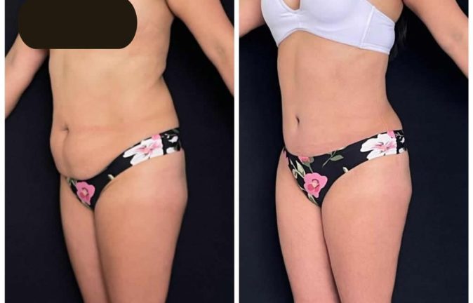 Abdominoplastias 1