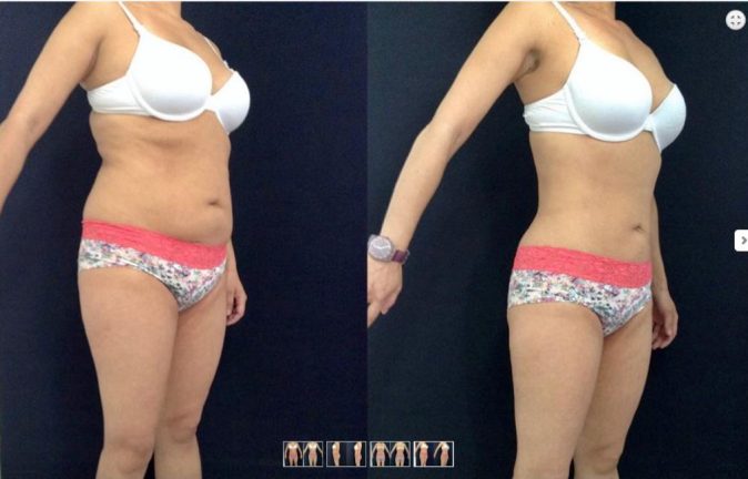 Abdominoplastias 11