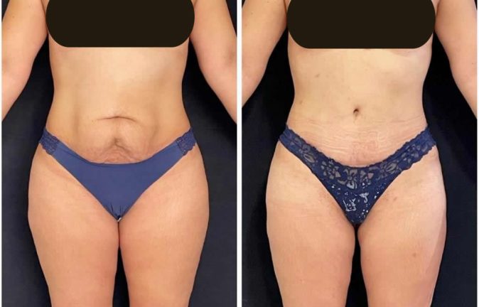 Abdominoplastias 14