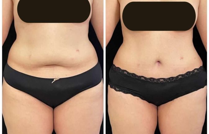 Abdominoplastias 15