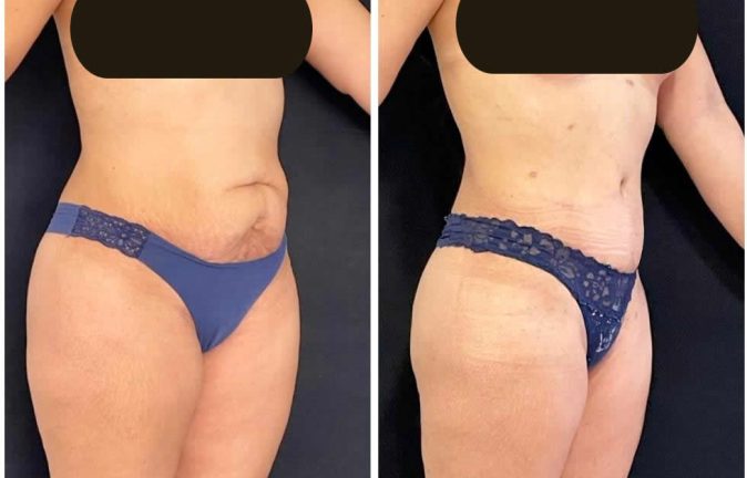 Abdominoplastias 16