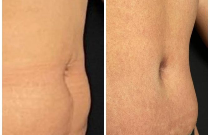 Abdominoplastias 2