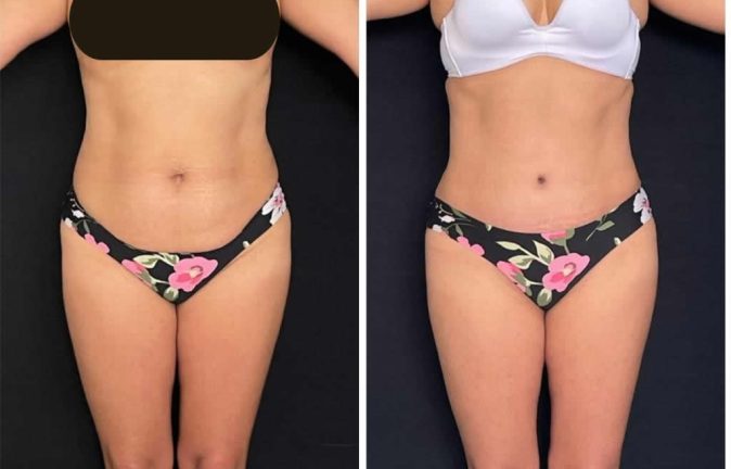 Abdominoplastias 3