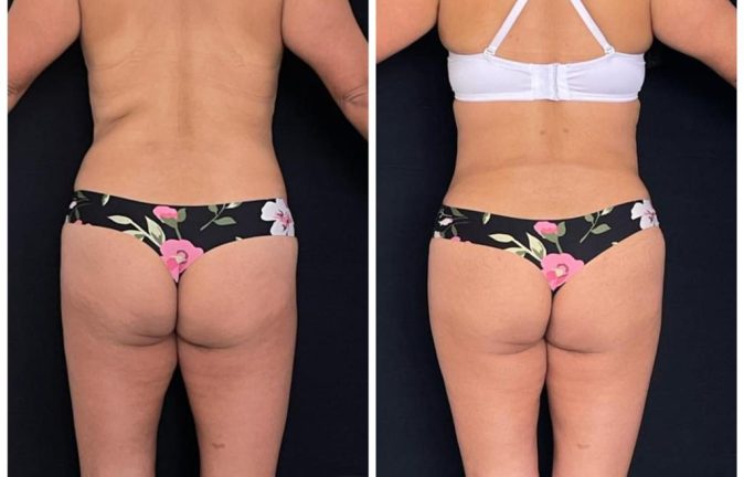 Abdominoplastias 5