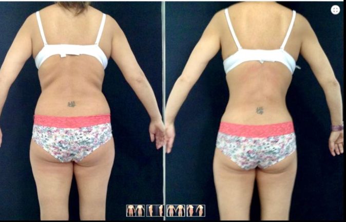 Abdominoplastias 8