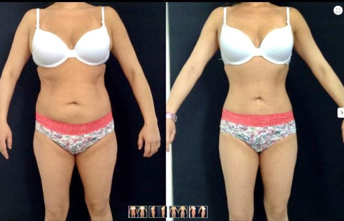 Abdominoplastias 9