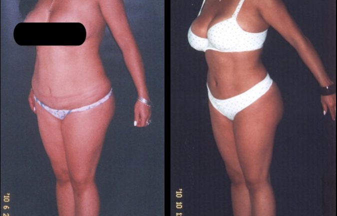 Abdominoplastias