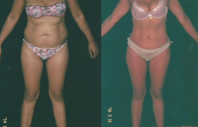 Abdominoplastias testimonios