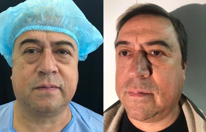 Blefaroplastia Hombres