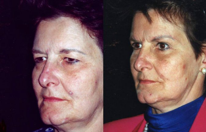 Blefaroplastia