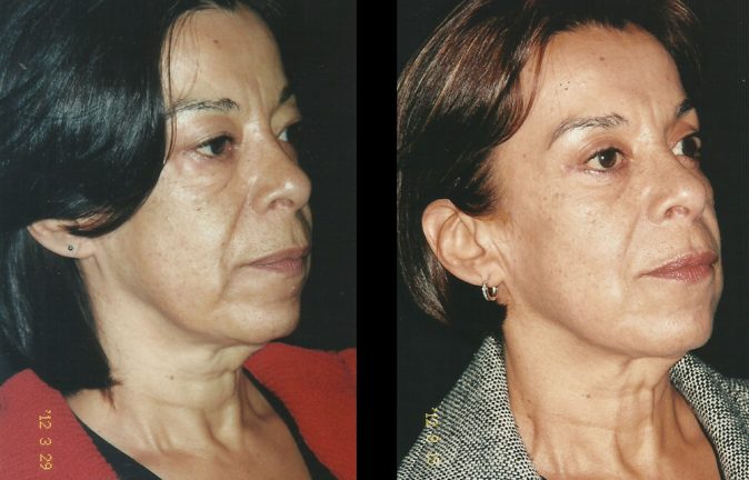 Cirugía Blefaroplastia