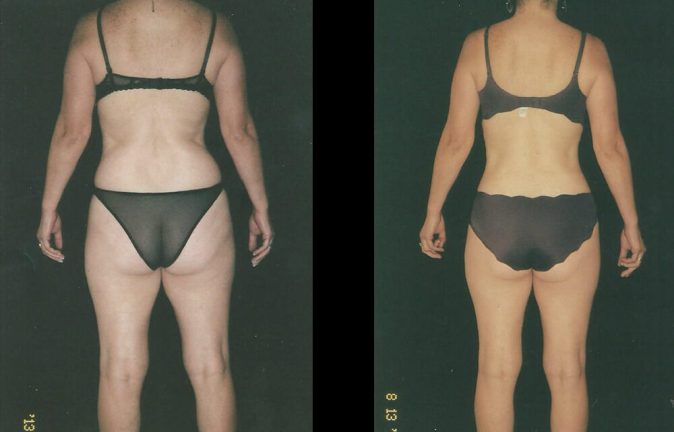 Cirugia de abdomen abdominoplastia testimonios