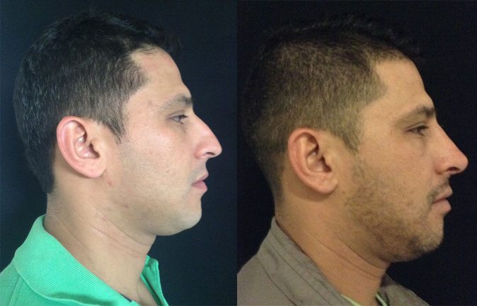 Cirugia de nariz Hombres