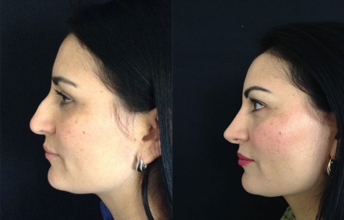 Cirugía de nariz antes y despues