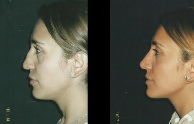 Cirugía de nariz en Bogotá