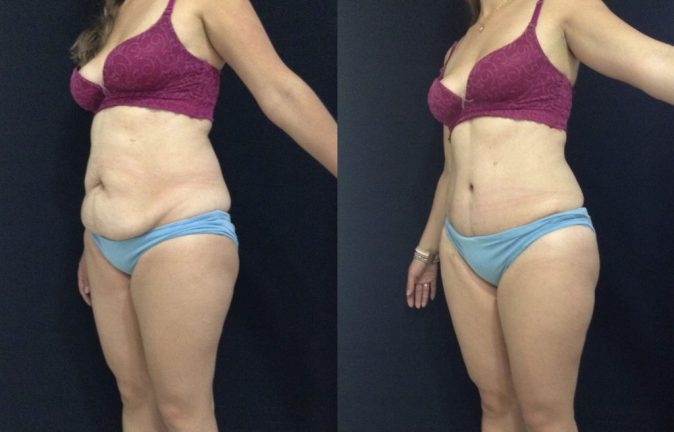 Cirugia estetica Abdominoplastia