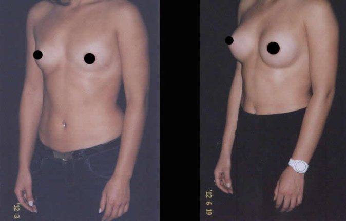 Cirugía mamoplastia
