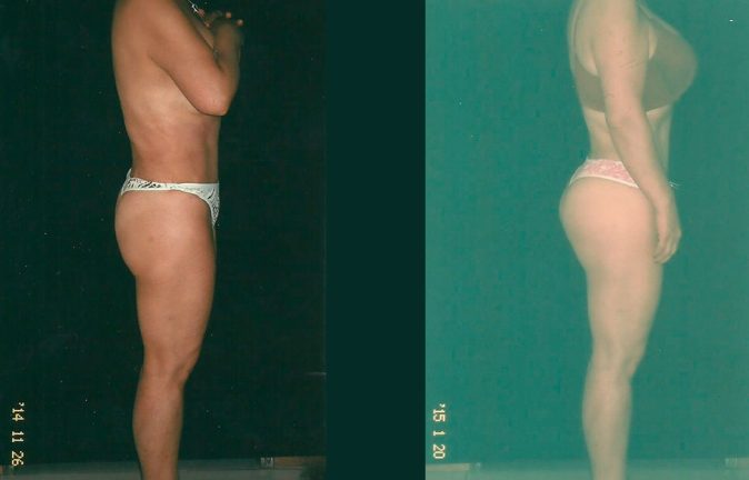 Cirugia plastica Gluteoplastia