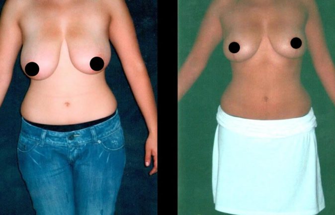 Cirugia plastica reduccion de senos