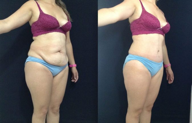 Cirugías Plásticas Abdominoplastia