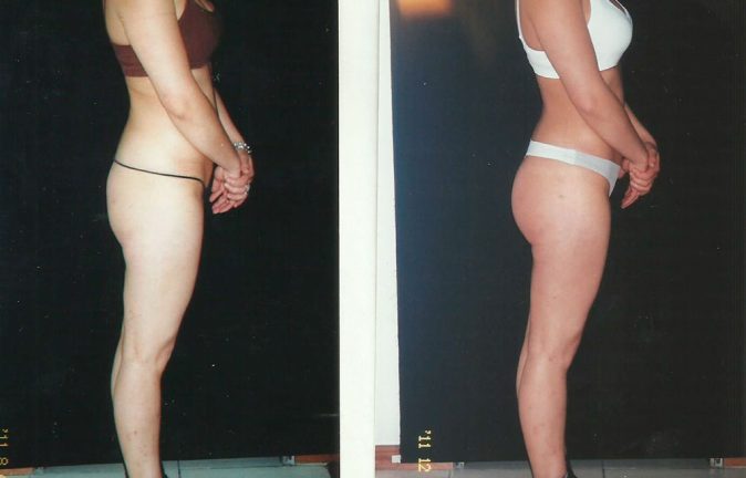 Gluteoplastia Testimonios