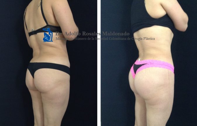 Gluteoplastia antes y despues