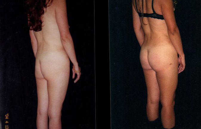 Gluteoplastia en Colombia