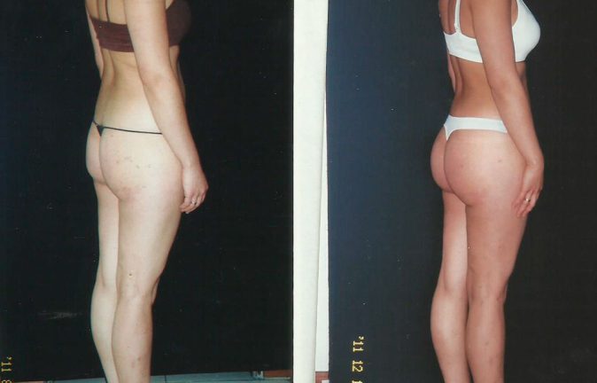 Gluteoplastia precios