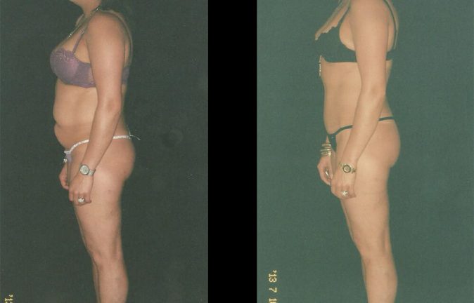 La abdominoplastia en Bogotá