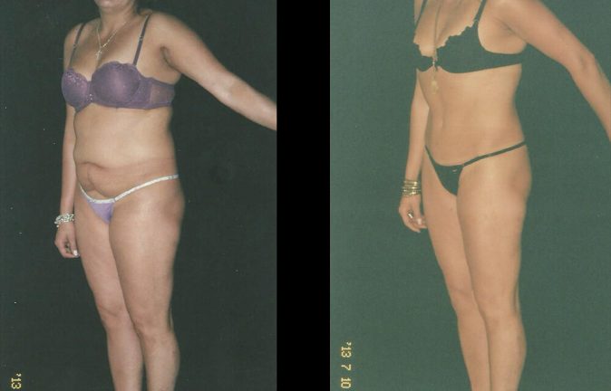 La abdominoplastia