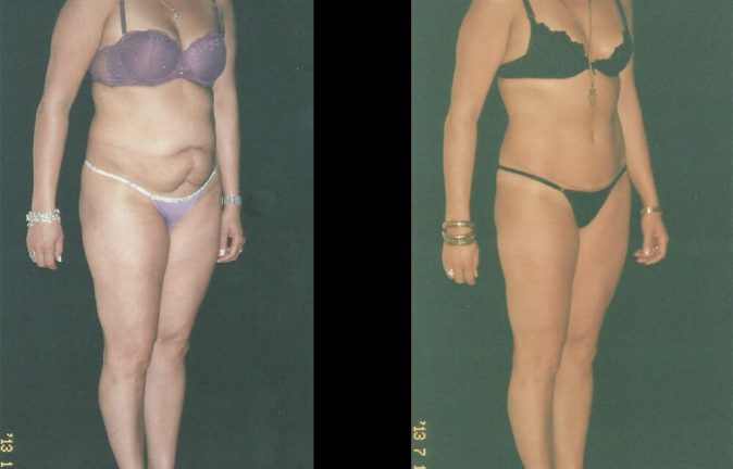 La abdominoplastia precios