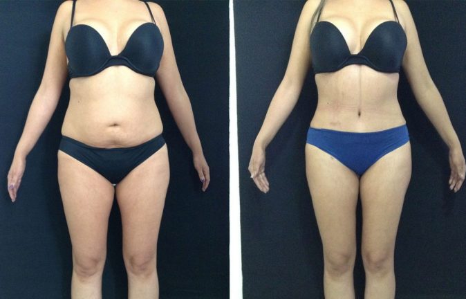 La cirugia de Abdominoplastia