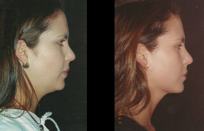 Lipo Papada antes y despues