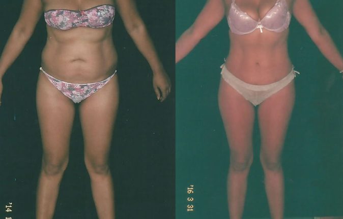 Lipo antes y despues