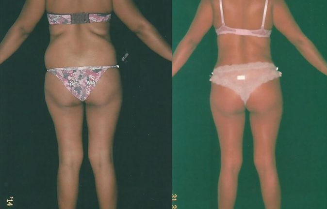 Lipo testimonios