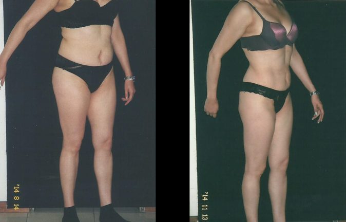 Liposuccion testimonios