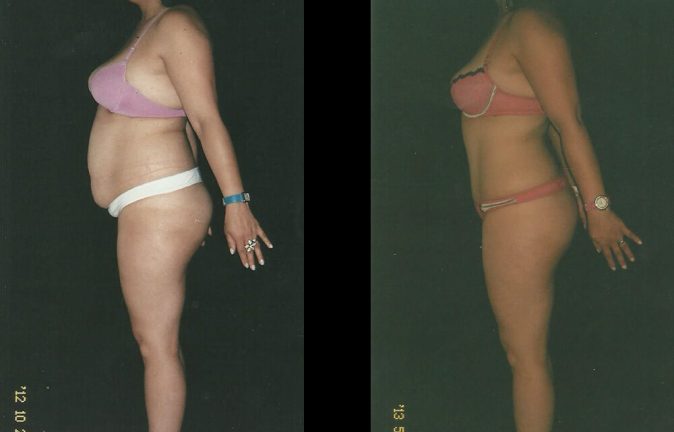 Liposucion antes y despues