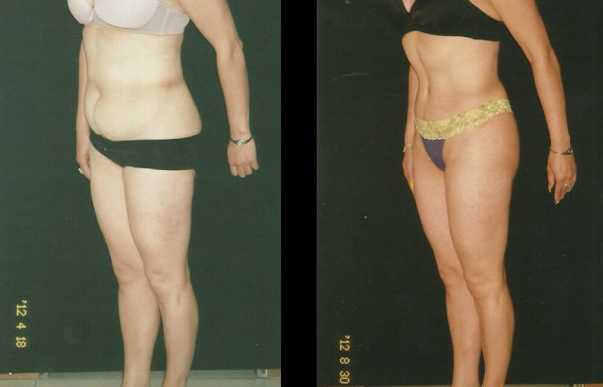 Liposucion testimonios