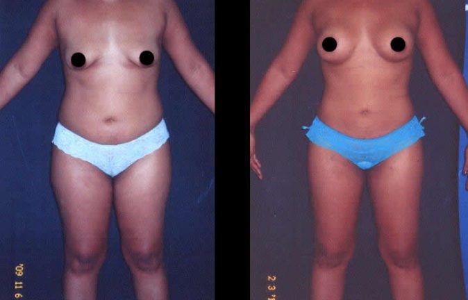 Mamoplastia Bogotá