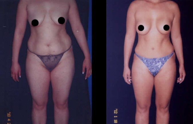 Mamoplastia Testimonios