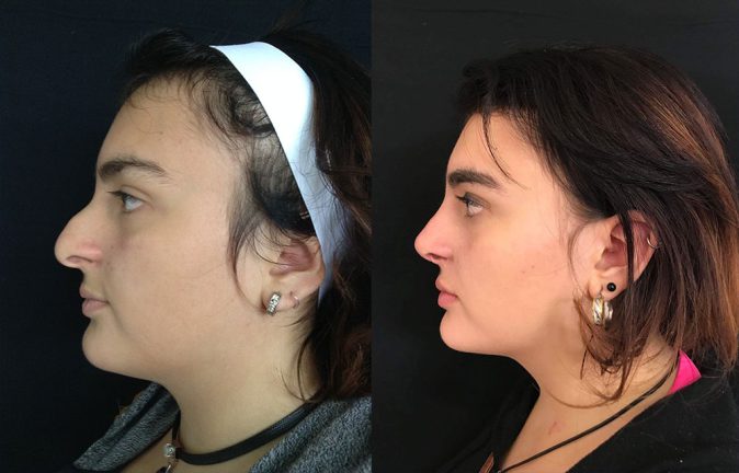 Rinoplastia Bogotá