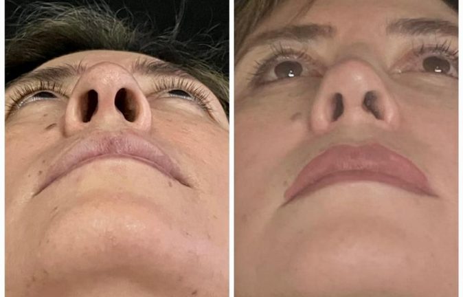 Rinoplastia Caso 32 Antes - Después 3