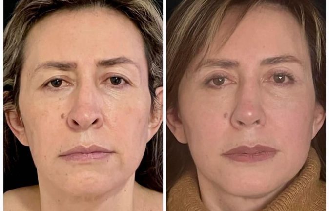 Rinoplastia Caso 32 Antes - Después