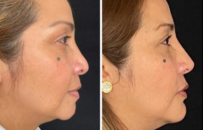 Rinoplastia Caso 35 Antes - Después 6